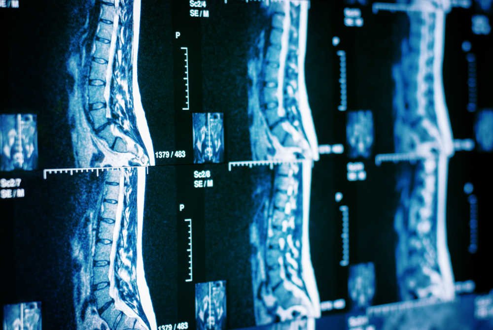 Taking on Paralysis, the Christopher & Dana Reeve Foundation Seeks to “Care and Cure”